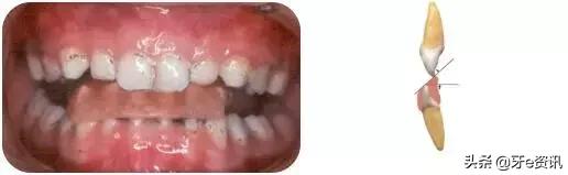 狗狗乳牙地包天怎么办,儿童乳牙地包天怎么办