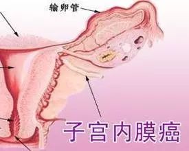 大姨妈来两次会不会得癌症,来大姨妈怎么查癌症