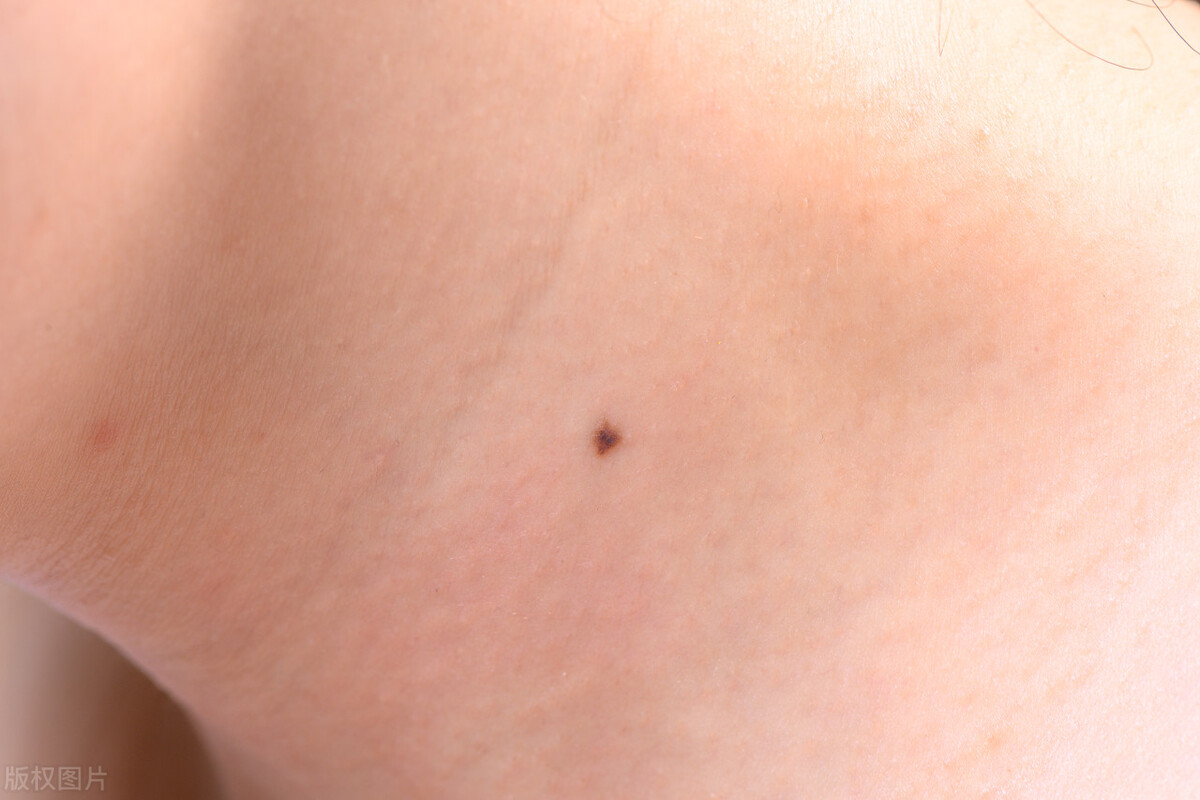 皮肤上的痣有可能是癌变吗,皮肤上长什么样的痣容易癌变
