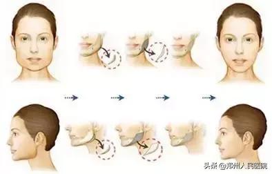 颧骨突出侧颜不好看怎么改善,颧骨宽太阳穴凹陷下颌骨宽改善