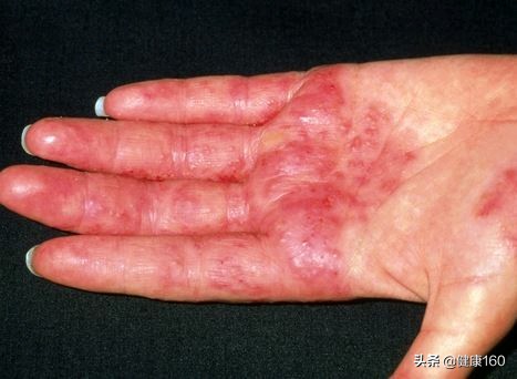 手部季节性脱皮有哪几种,手部脱皮严重是什么样的