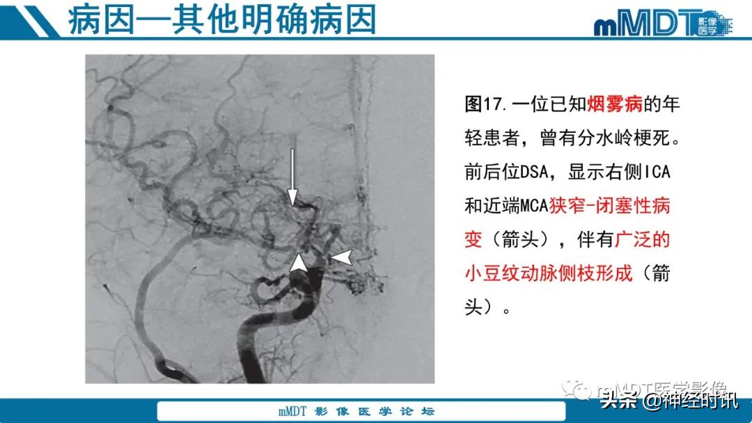 急性缺血性脑卒中ppt素材图片,青年缺血性脑卒中ppt