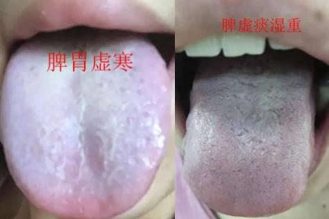 脾虚齿痕舌吃什么中成药,身上没劲乏力肚子难受怎么回事