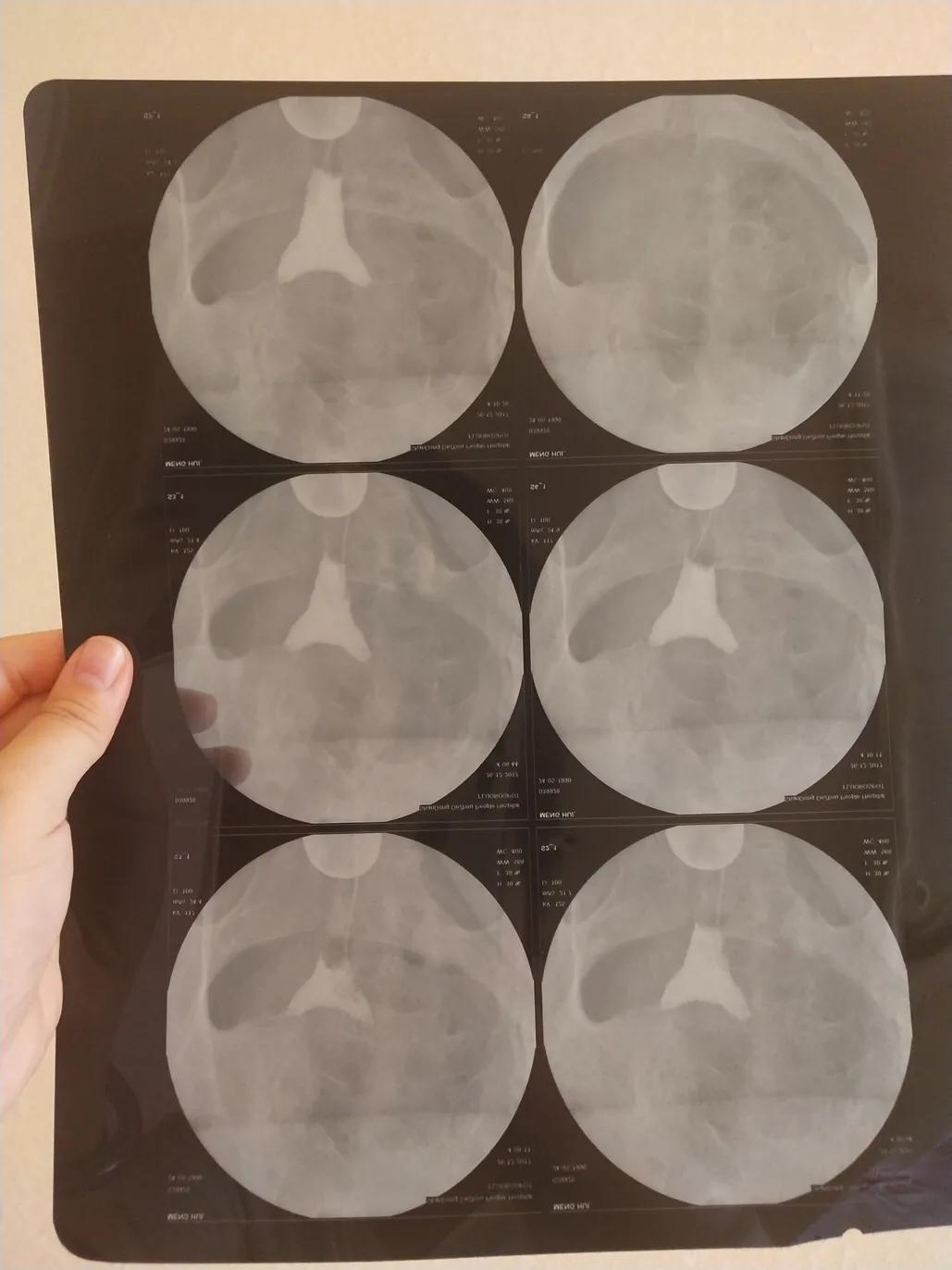 双侧输卵管不通自然怀孕了,双侧输卵管通而不畅能自然怀孕吗
