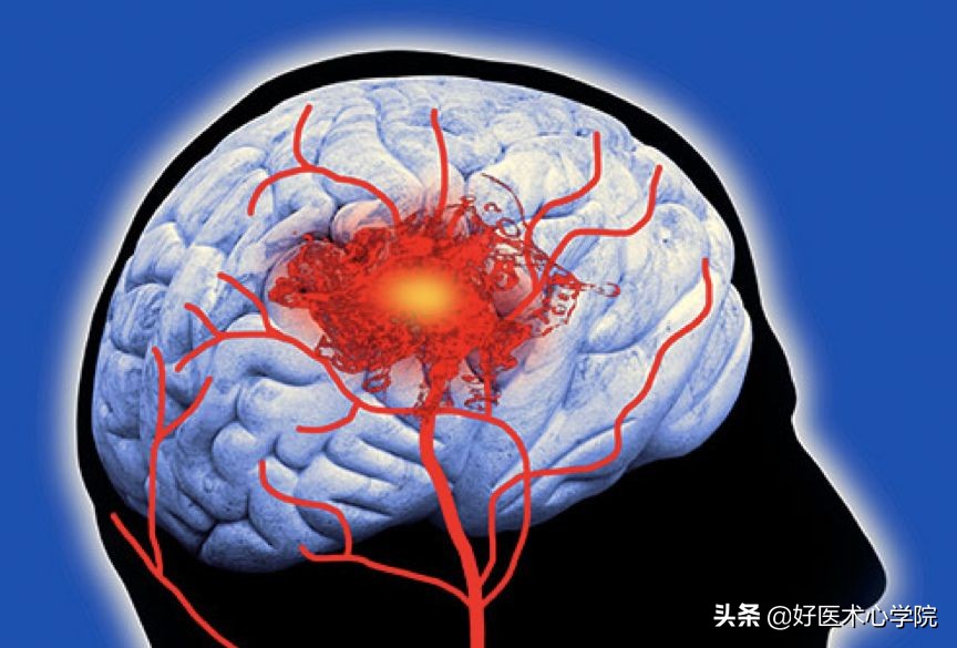 最常见的血栓类型是,最致命血栓视频