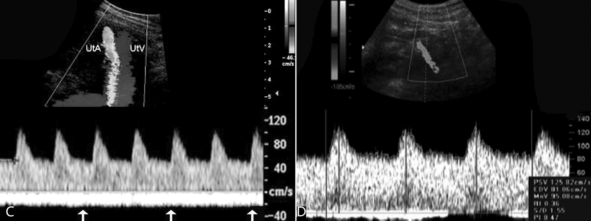 盆腔血管彩色多普勒超声孕期检查,明明白白做ct检查