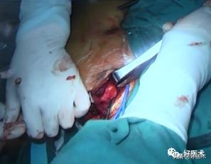 肩锁关节脱位手术后多久可以喝酒,肩锁关节脱位钢板内固定步骤记录