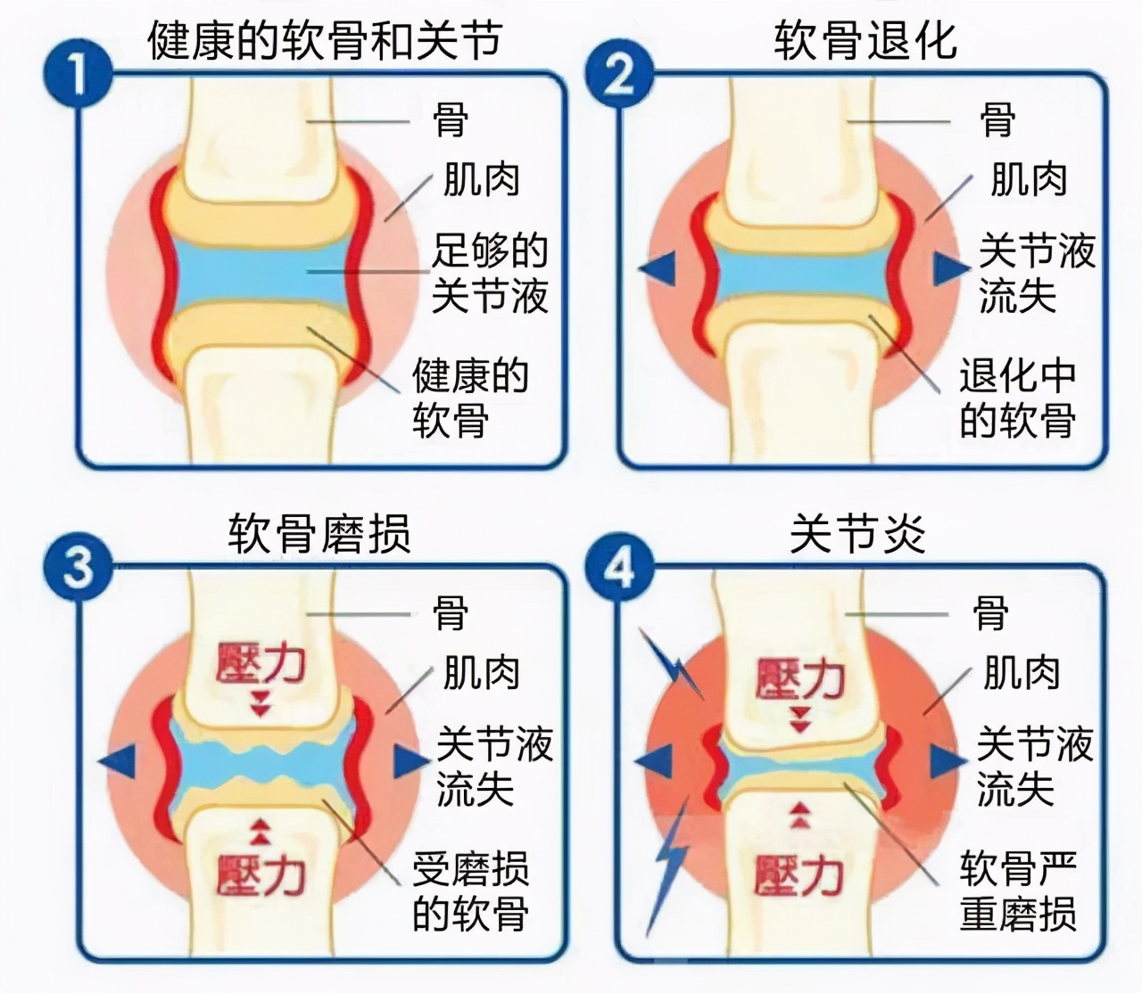 硫酸软骨素与氨糖哪种治关节好,硫酸氨基葡萄糖与盐酸哪个效果好
