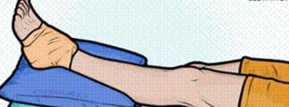 医生讲解脚扭伤问题,急性脚扭伤正确的处理方法