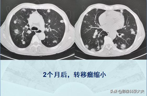 癌症晚期肺转移还能活多久,肺癌症晚期能有必要化疗吗