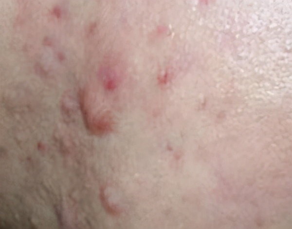 痘坑变黑了增生疤痕凸起怎么去除,红色凸起痘印怎么去除