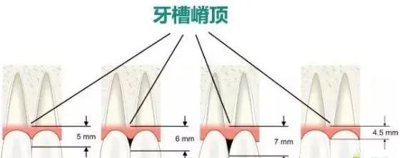 牙齿黑三角区怎么办,牙齿黑三角怎么改善