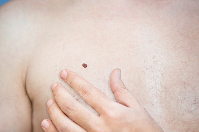 脸上怎么祛痣祛斑,脸上的痣怎么无痛祛痣