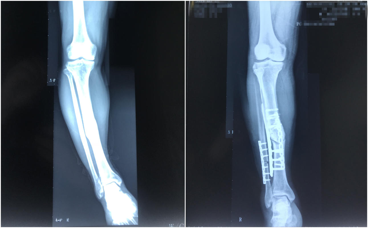 骨折21天自行拆石膏可以吗,骨折以后45天自行拆石膏