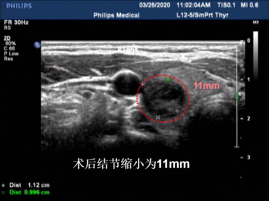哈尔滨微创消融甲状腺结节哪家好,甲状腺结节微创消融术的过程