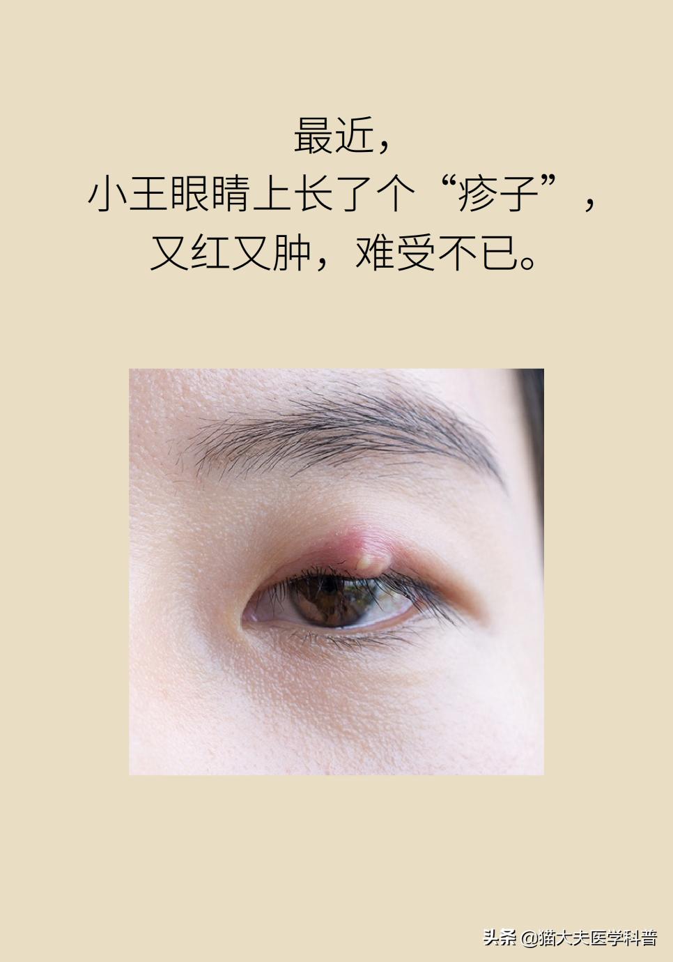 爱长针眼怎么回事,爱长针眼咋整