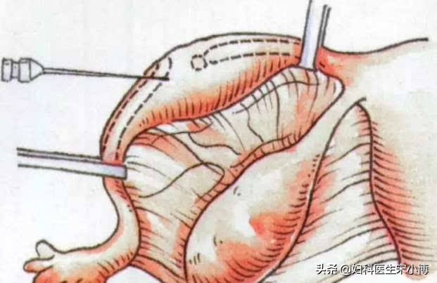 你了解宫外孕吗,输卵管间质部堵塞会宫外孕吗