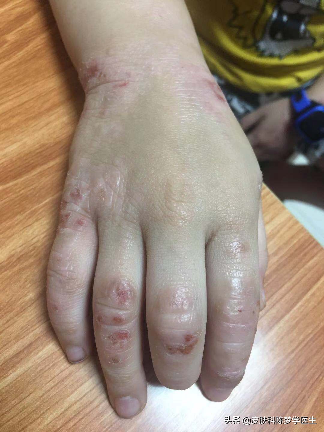 藿香正气水治湿疹,马齿苋煮水治湿疹