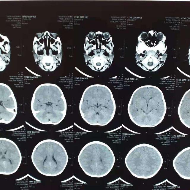 硬膜外血肿意识清醒需要手术吗,急性硬膜外血肿可做什么检查