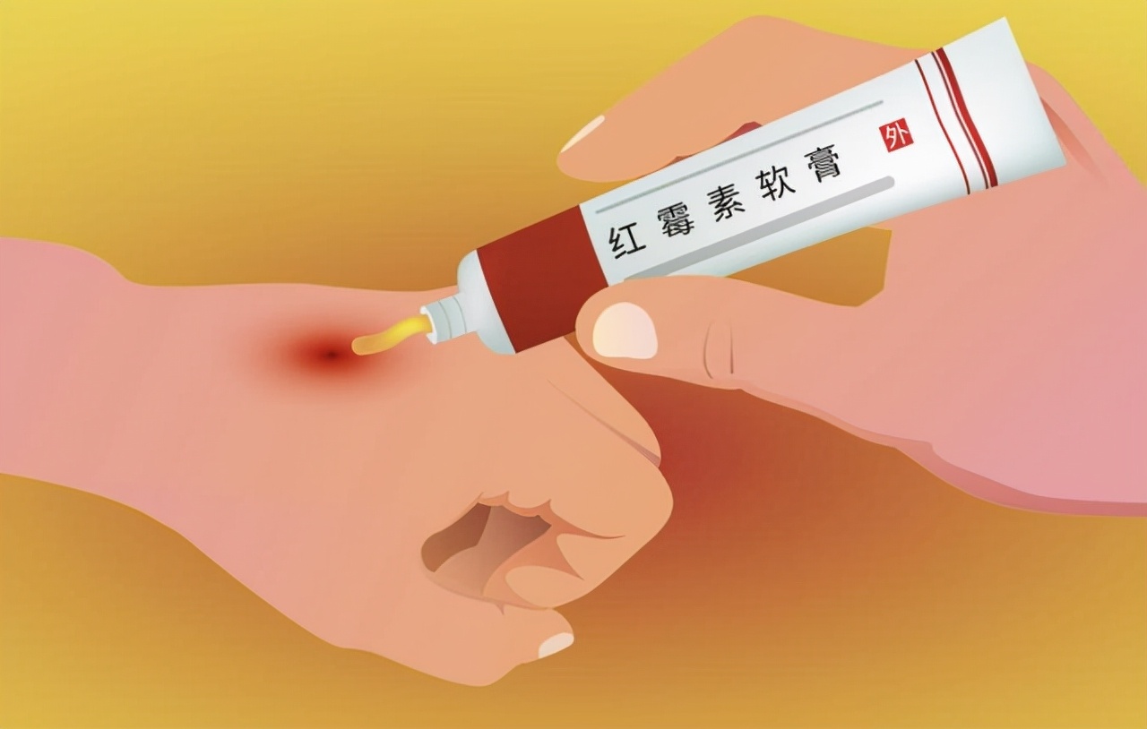 红霉素软膏的作用对痘痘有什么用,红霉素软膏作用与功效能治脚气吗