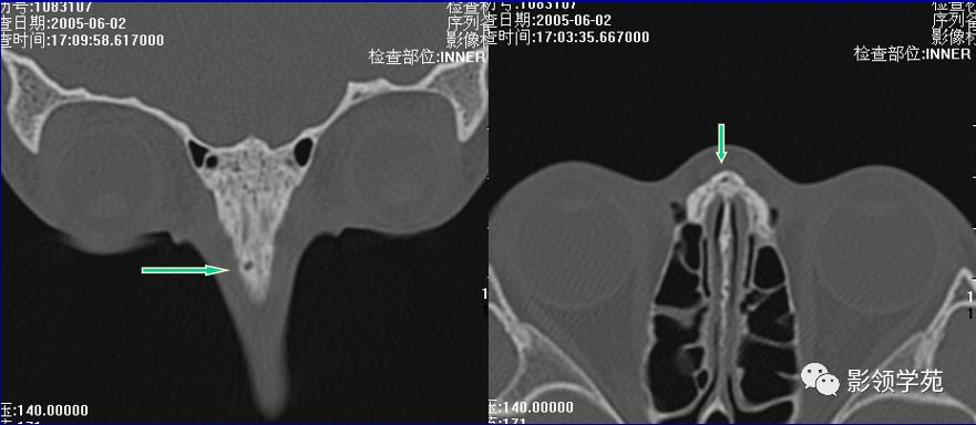 鼻骨影像学解剖,鼻骨解剖及骨折影像学诊断
