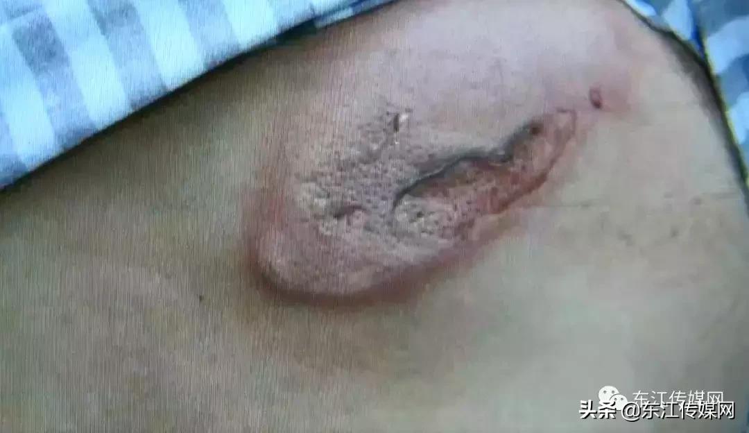 17岁女孩被电晕,女孩在景观池触电事故