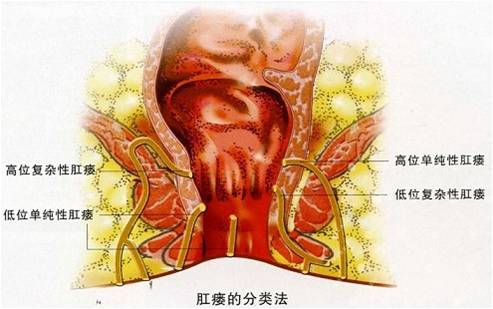 肛瘘手术比生孩子还疼吗,肛瘘手术疼痛可以承受吗