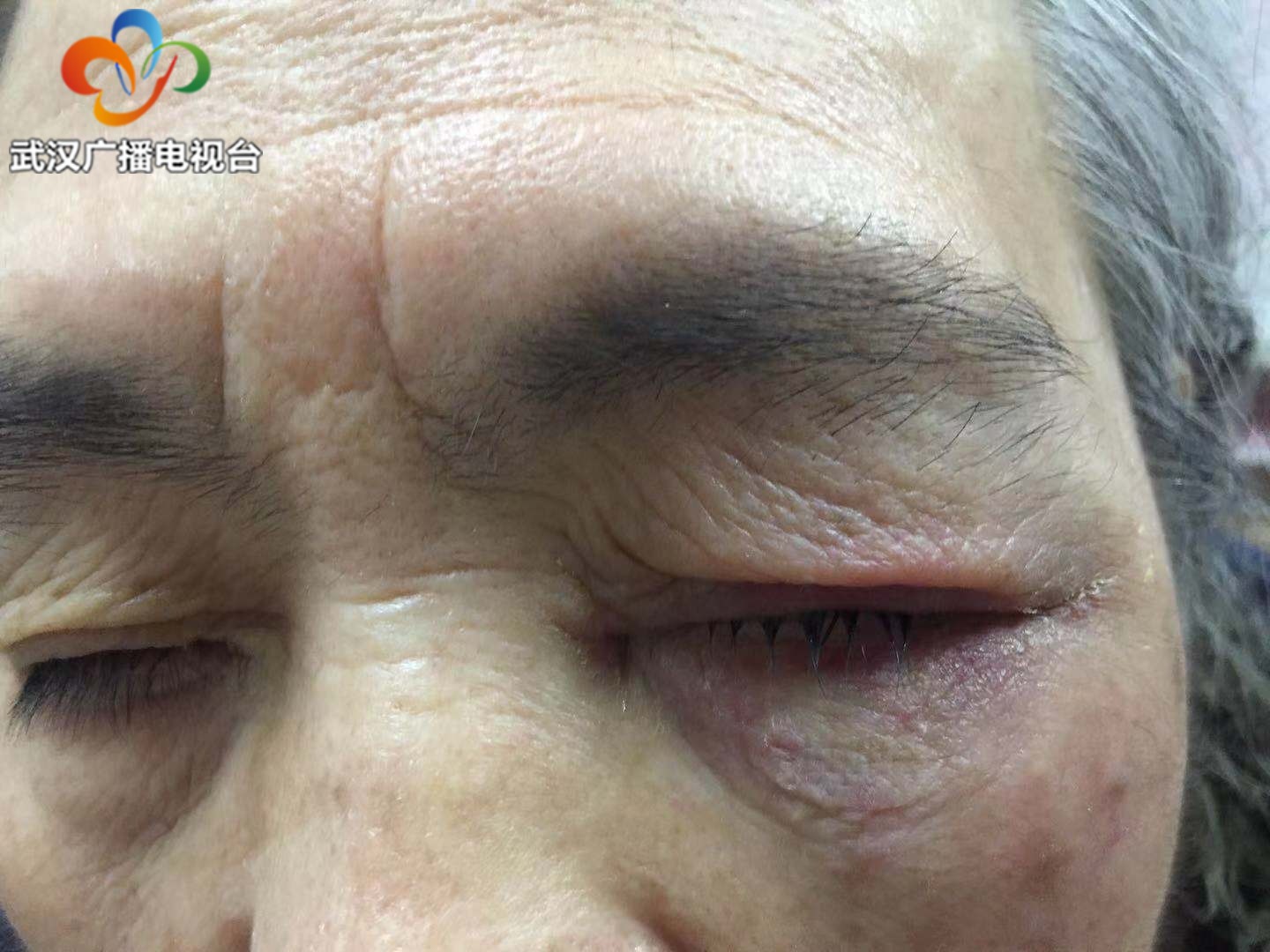 眼睛被灰指甲药水烧伤怎么办,灰指甲药水进了眼睛发炎了怎么办