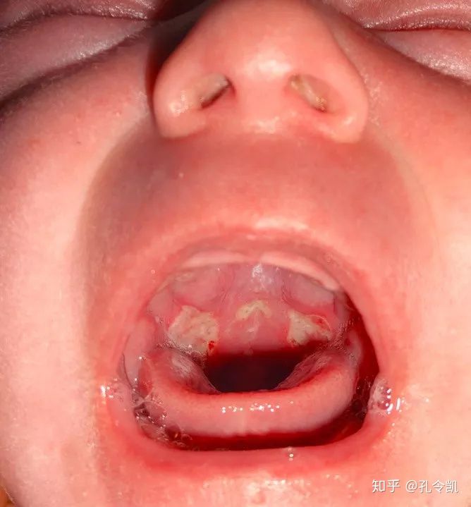 喂奶姿势不当导致孩子兜齿怎么办,宝宝喂奶姿势不对导致的口腔问题