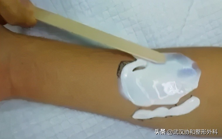 激光洗纹身出血吗,洗纹身是什么体验