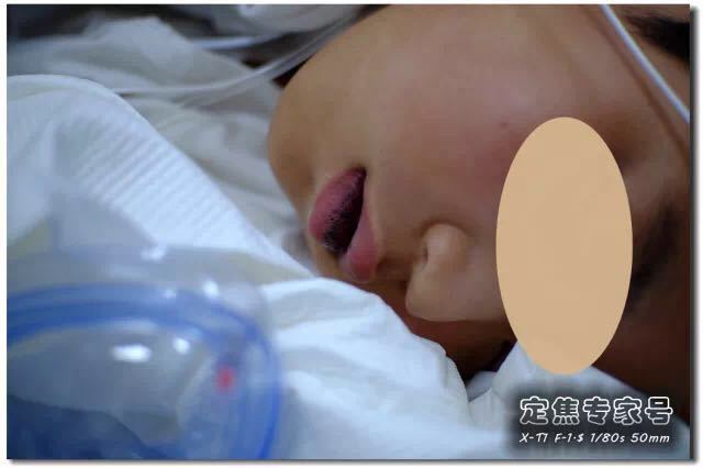 肠道息肉嘴唇黑斑,嘴唇上有黑点是肠道息肉吗