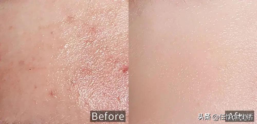 刷酸为什么避开脸颊,刷酸会垮脸吗