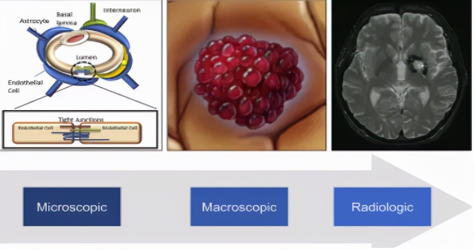 颅内海绵状血管瘤能治好吗,什么是颅内海绵状血管瘤