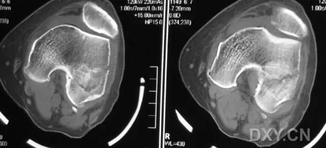 特殊骨折类型,特殊骨折体征
