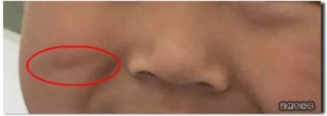 小孩脸上摔了口子能缝针吗,小孩脸摔破皮结痂后可以抹芦荟吗