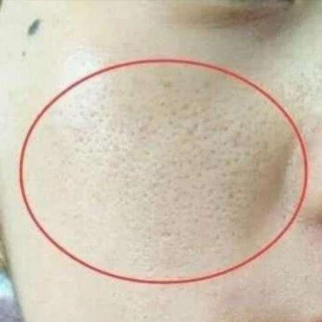 100人里就有20人中招，清洁不到位导致脸上冒虫，毛孔需要早清洁