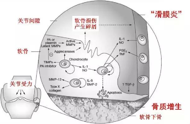滑膜炎是不是炎症,骨质增生膝盖疼痛膝盖积液滑膜炎