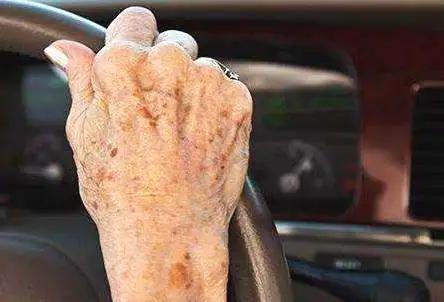 脱发大多是不是有什么病,脱发是衰老的表现吗