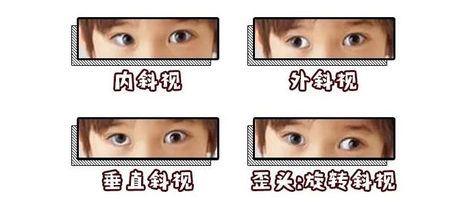 小孩眼睛斜视能不能矫正过来,宝宝眼睛斜视治疗费用