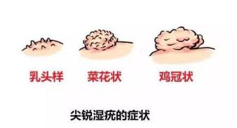 尖锐性湿疣怎么治多少钱,尖锐性湿疣怎么治需要多少钱