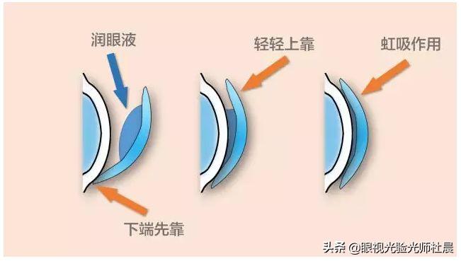 初次戴隐形眼镜感觉有点眩晕,初次戴隐形眼镜怎么取下来