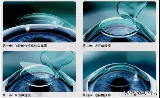 飞秒激光近视手术有什么副作用,矫正近视手术有什么副作用