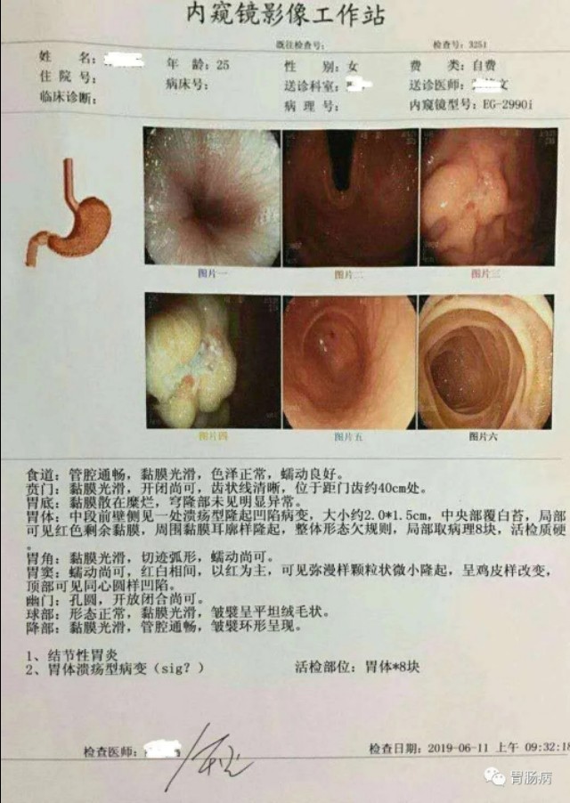 女子体检检查胃癌晚期,女孩体检发现癌症后续