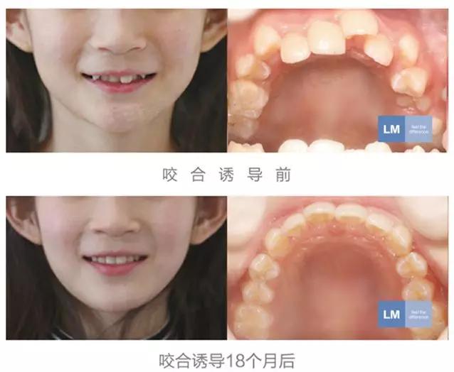 儿童牙齿早期干预矫正有几种,儿童牙齿早期矫正图片