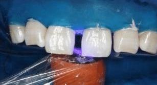 门牙缝可以补吗,门牙有缝怎么办如何补救