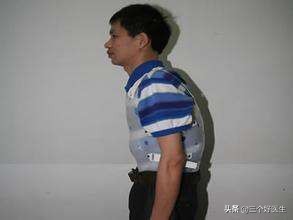 强直性脊椎炎的正骨治疗及预防