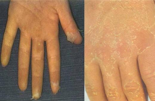 猩红热是疹子先出现还是发烧,猩红热出疹子后体温低烧