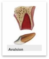 牙齿断了把牙根拔出,牙齿断了拿另一半能补吗