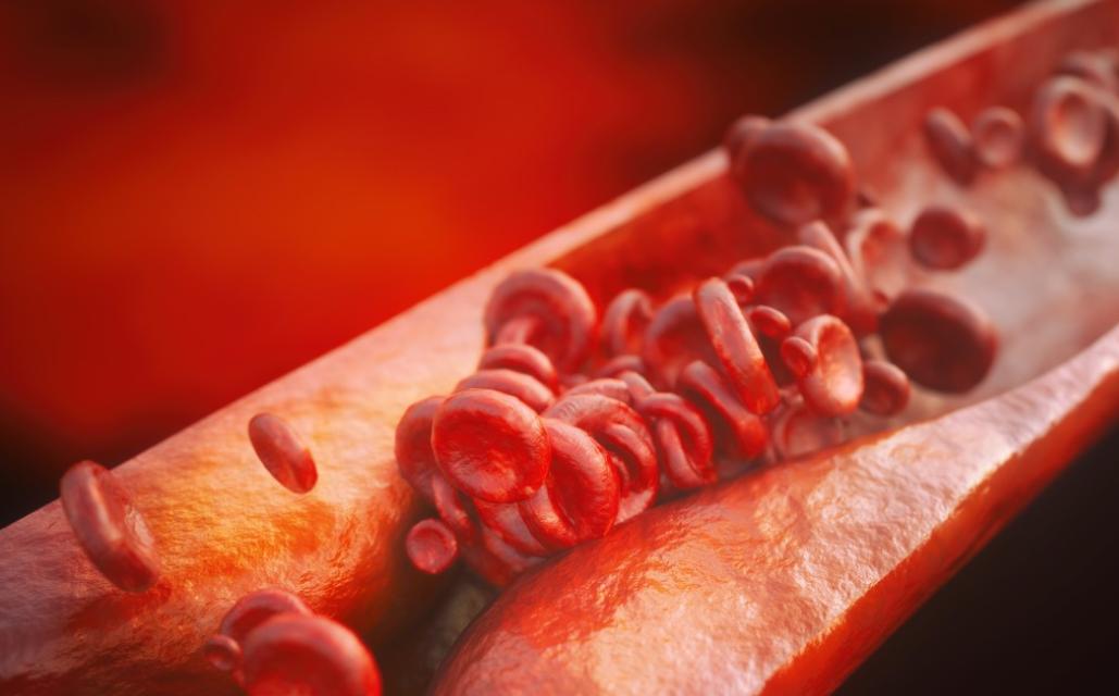 心血管堵塞造影70%需要放支架吗,心血管堵80%怎么症状不明显