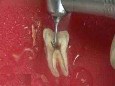 牙齿反复发炎,吃药也没用!该怎么治疗才好?